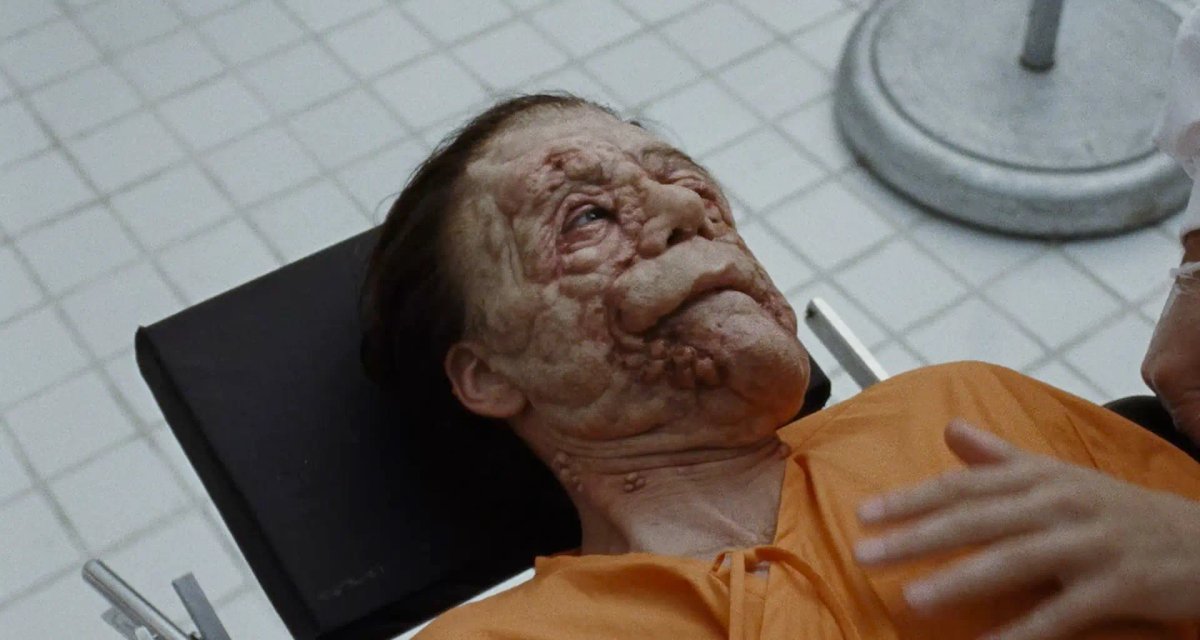 Edward (Sebastian Stan) prima del trattamento medico in A Different Man.